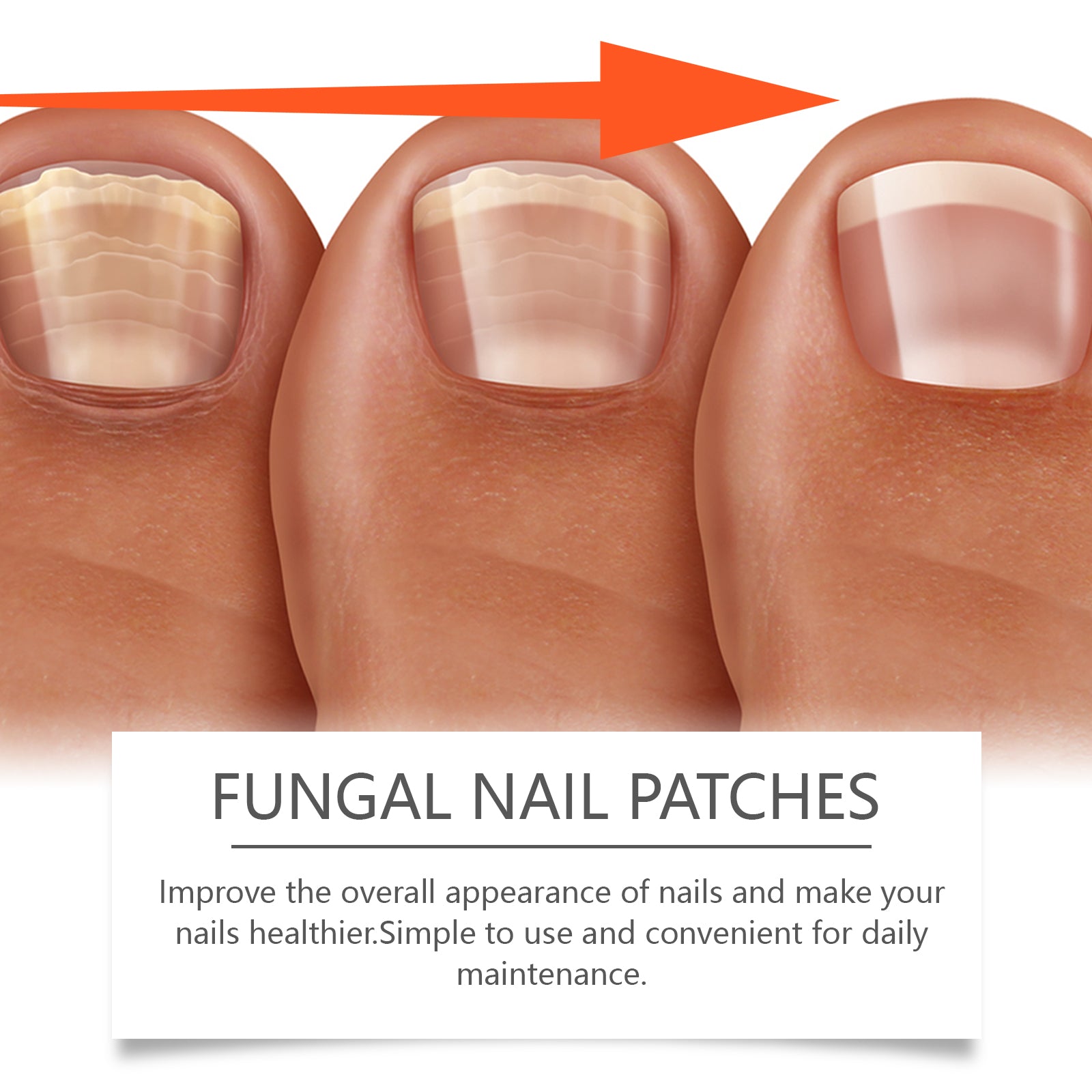 Ximonth Nail Care Patches for Nail Repair &amp; Easy Cleaning shown improving nail appearance for healthier nails.